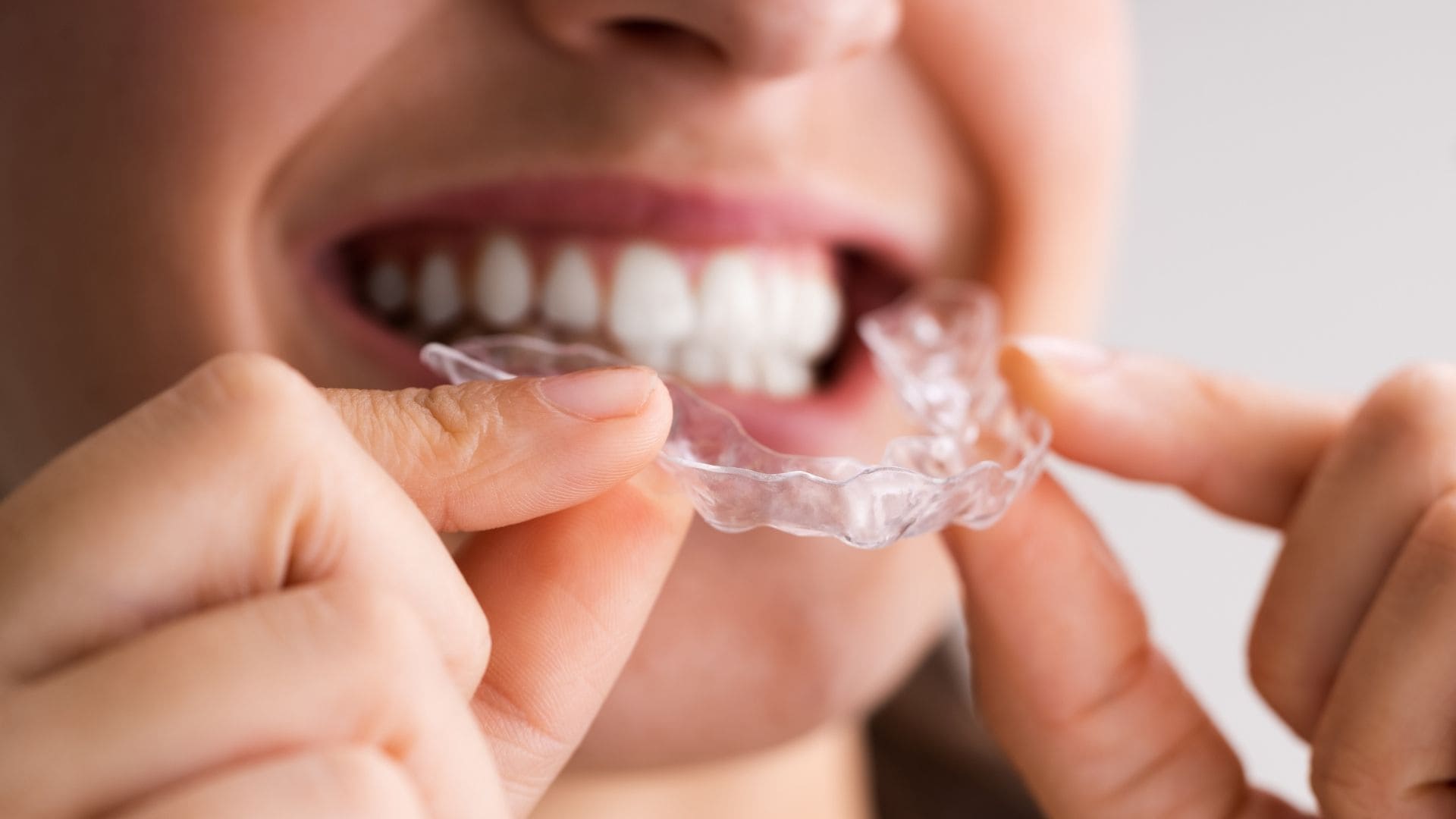 Clear Aligners in Sec 93