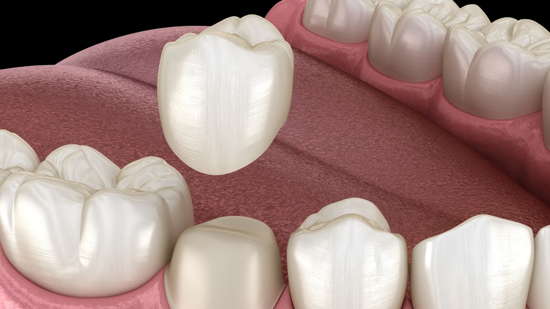 Dental Crowns and Bridges in Sector 93 Noida NCR