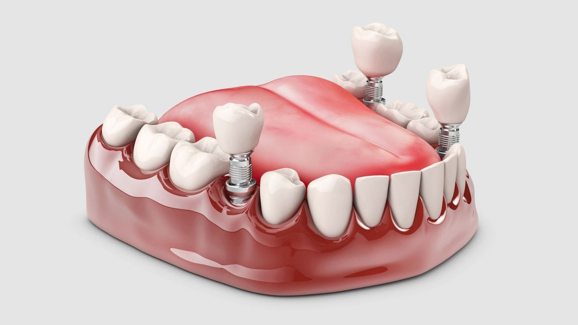 Dental Implants in Sector 93 Noida