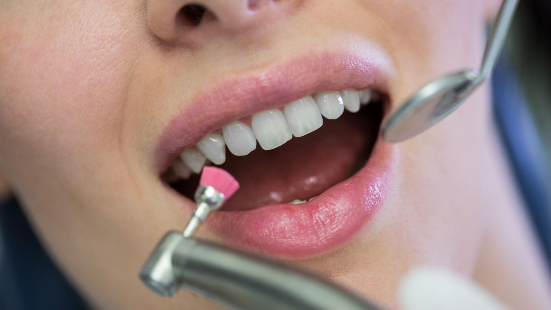 Teeth Scaling and Polishing in Noida